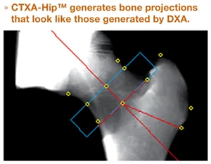 Mindways CTXA-Hip femur analizi